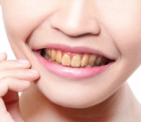 Deep teeth Whitening before HadijeOsmankaj