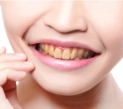 Deep teeth Whitening before HadijeOsmankaj